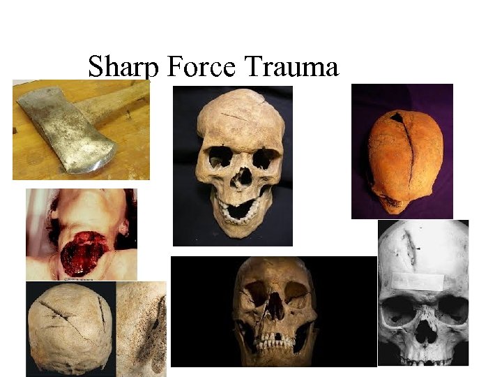 Sharp Force Trauma 