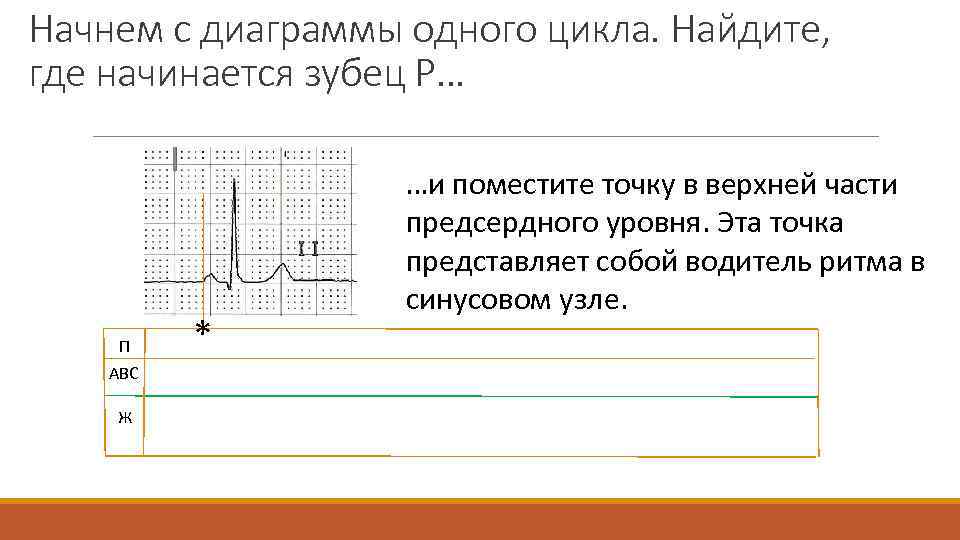 Начнем с диаграммы одного цикла. Найдите, где начинается зубец P… П АВС Ж *