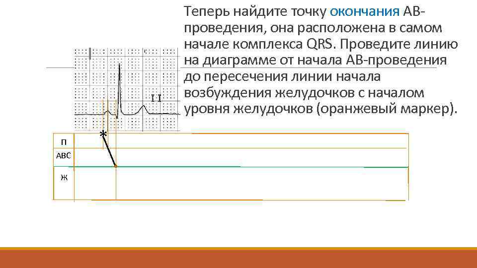 Теперь найдите точку окончания АВпроведения, она расположена в самом начале комплекса QRS. Проведите линию