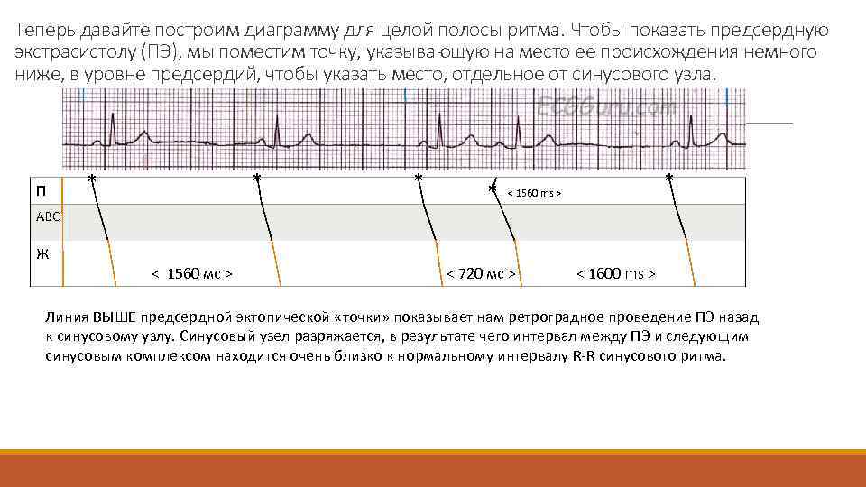 Теперь давайте построим диаграмму для целой полосы ритма. Чтобы показать предсердную экстрасистолу (ПЭ), мы