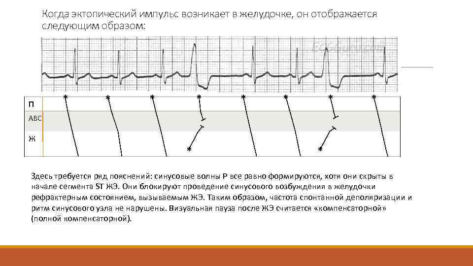 Когда эктопический импульс возникает в желудочке, он отображается следующим образом: П * * *