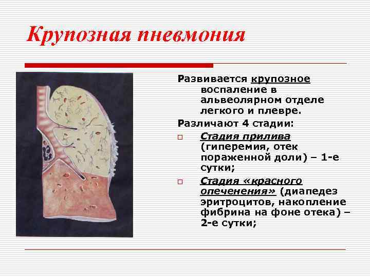 Крупозная пневмония Развивается крупозное воспаление в альвеолярном отделе легкого и плевре. Различают 4 стадии: