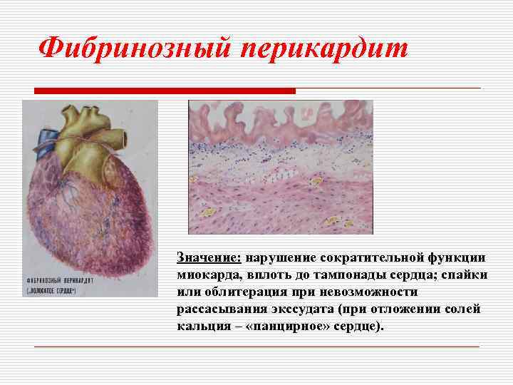 Фибринозный перикардит Значение: нарушение сократительной функции миокарда, вплоть до тампонады сердца; спайки или облитерация