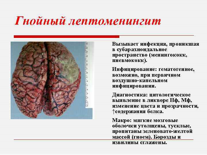 Гнойный лептоменингит Вызывает инфекция, проникшая в субарахноидальное пространство (менингококк, пневмококк). Инфицирование: гематогенное, возможно, при