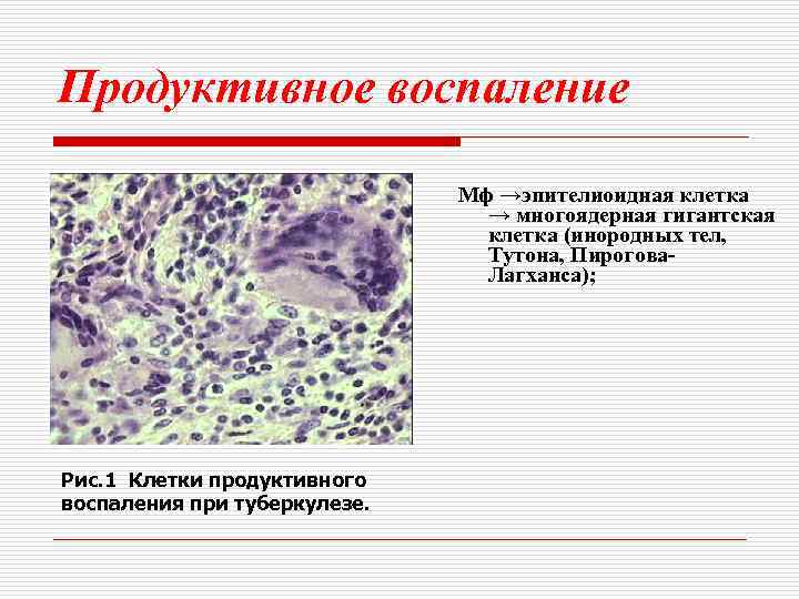 Продуктивное воспаление Мф →эпителиоидная клетка → многоядерная гигантская клетка (инородных тел, Тутона, Пирогова. Лагханса);