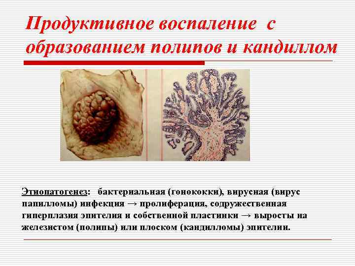 Продуктивное воспаление с образованием полипов и кандиллом Этиопатогенез: бактериальная (гонококки), вирусная (вирус папилломы) инфекция