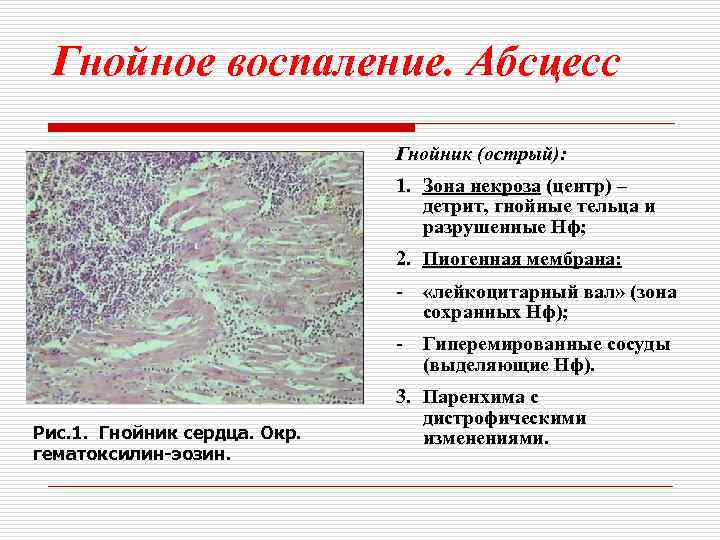 Стадии гнойного воспаления