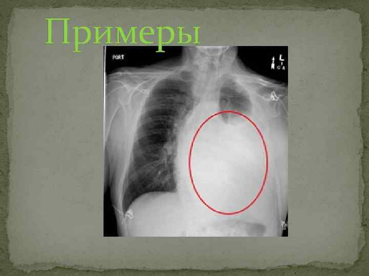 Синусы облитерированы. Облитерирован синус легких рентген. Верхнее легочное поле. Веретенообразное затемнение рентген. Синдром обширного затемнения.