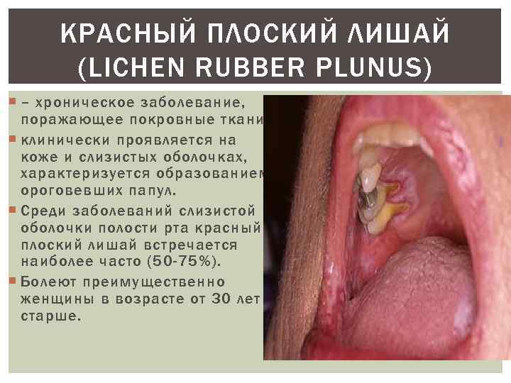 КРАСНЫЙ ПЛОСКИЙ ЛИШАЙ (LICHEN RUBBER PLUNUS) – хроническое заболевание, поражающее покровные ткани; клинически проявляется