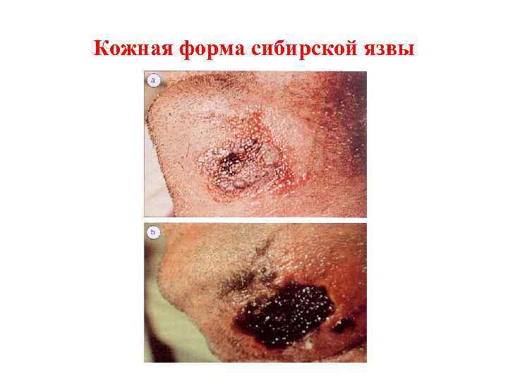 Кожная форма сибирской язвы 