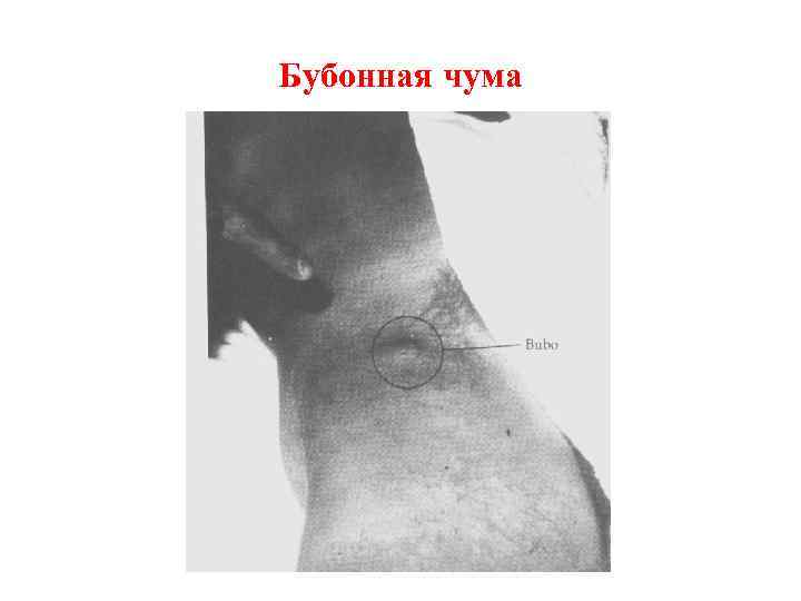 Бубонная чума 