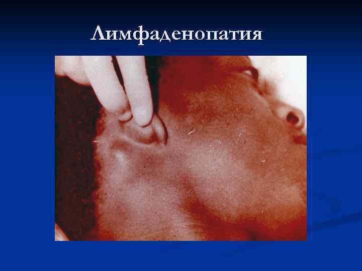 Лимфаденопатия 