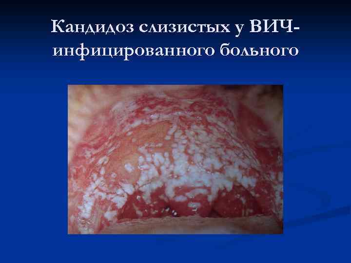 Кандидоз слизистых у ВИЧинфицированного больного 