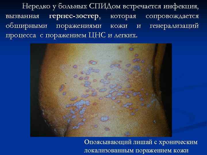 Нередко у больных СПИДом встречается инфекция, вызванная герпес-зостер, которая сопровождается обширными поражениями кожи и