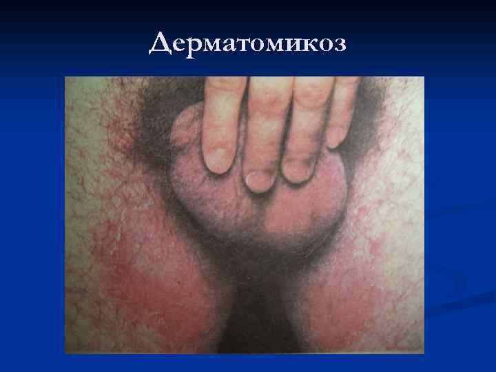 Дерматомикоз 