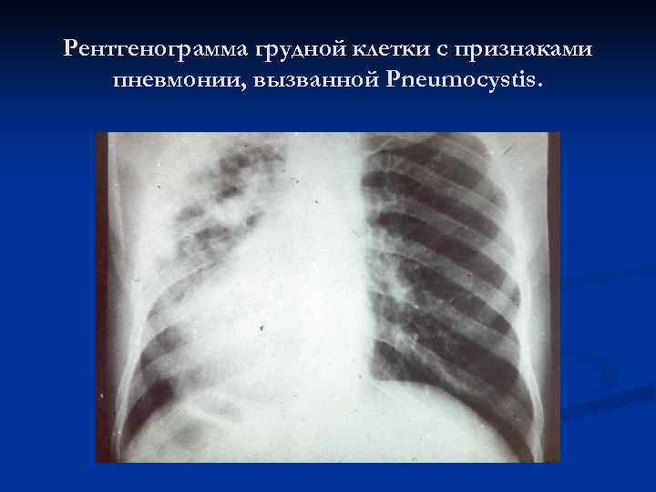 Рентгенограмма грудной клетки с признаками пневмонии, вызванной Pneumocystis. 