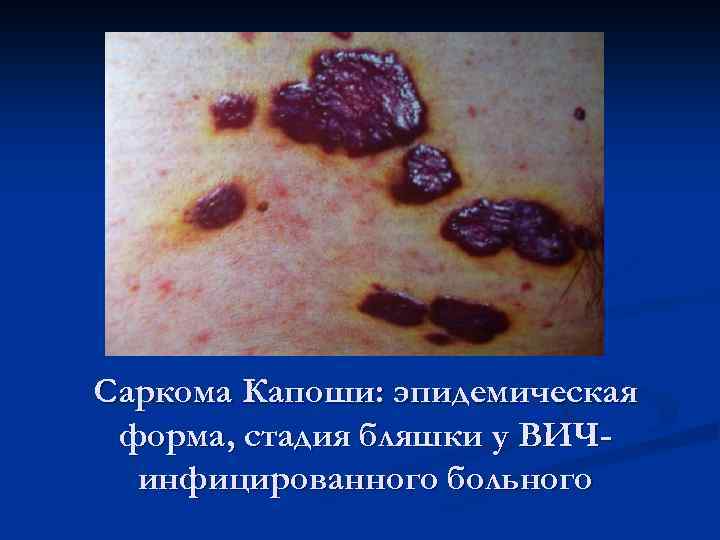 Саркома Капоши: эпидемическая форма, стадия бляшки у ВИЧинфицированного больного 