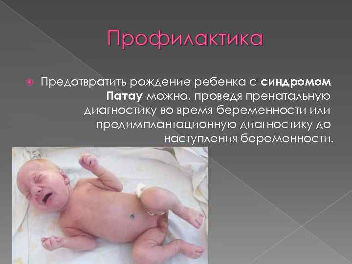 Профилактика Предотвратить рождение ребенка с синдромом Патау можно, проведя пренатальную диагностику во время беременности