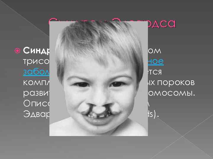 Синдром Эдвардса Синдром Э двардса (синдром трисомии 18) — хромосомное заболевание, характеризуется комплексом множественных