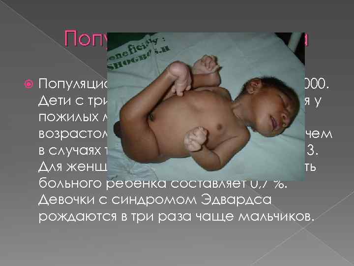 Популяционная частота примерно 1: 7000. Дети с трисомией 18 чаще рождаются у пожилых матерей,