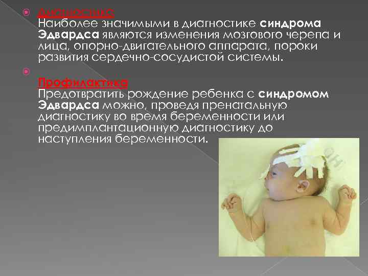  Диагностика Наиболее значимыми в диагностике синдрома Эдвардса являются изменения мозгового черепа и лица,