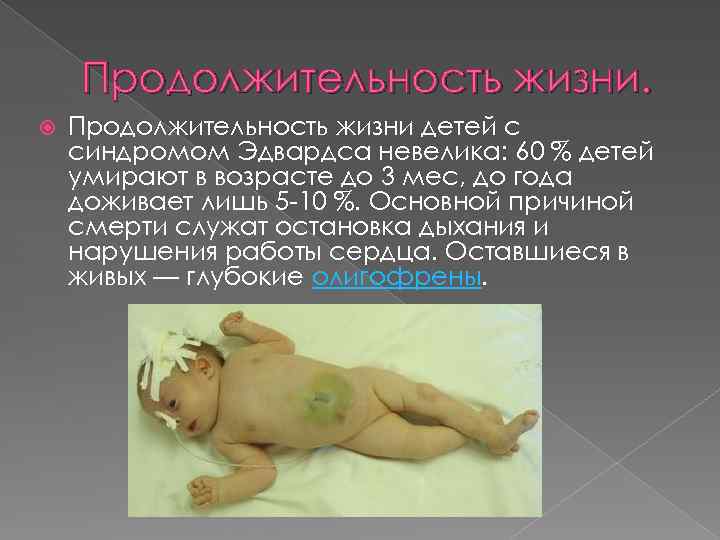 Продолжительность жизни детей с синдромом Эдвардса невелика: 60 % детей умирают в возрасте до