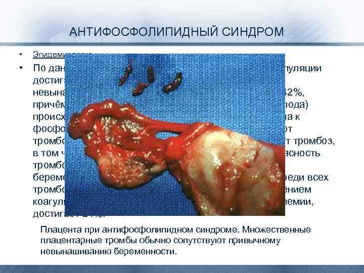 АНТИФОСФОЛИПИДНЫЙ СИНДРОМ • Эпидемиология • По данным американских авторов, частота АФС в популяции достигает