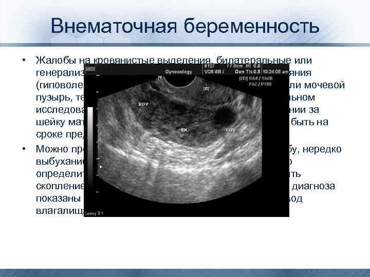 Внематочная беременность симптомы признаки на раннем сроке. Внематочная беременность. Внематочная беременность на УЗИ. Трубная беременность УЗИ. Внематочная беременность это беременность.