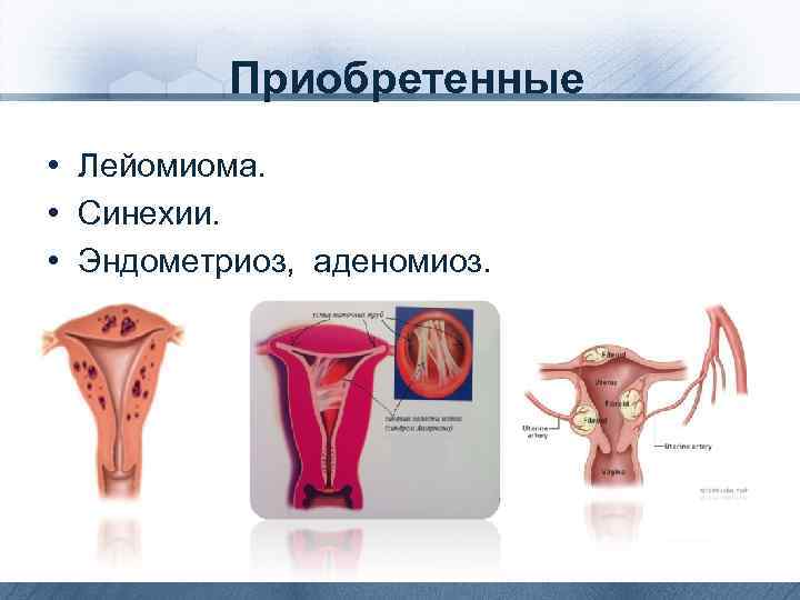 Приобретенные • Лейомиома. • Синехии. • Эндометриоз, аденомиоз. 