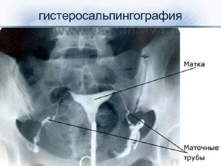 гистеросальпингография 