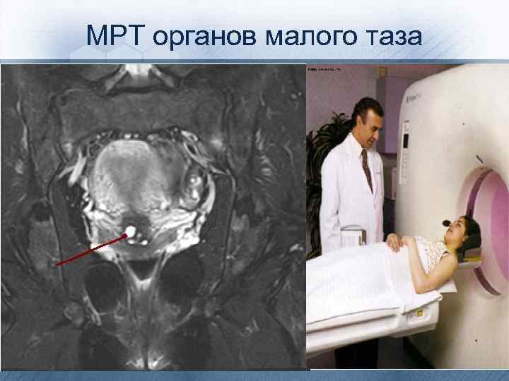 МРТ органов малого таза 