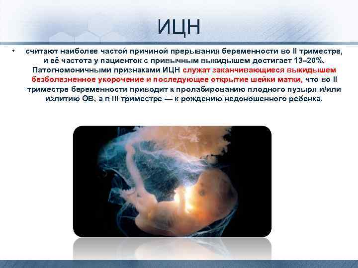 ИЦН • считают наиболее частой причиной прерывания беременности во II триместре, и её частота