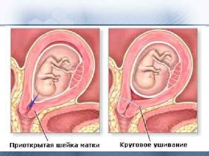  • Основными методами оперативного лечения являются механическое сужение функционально и (или) анатомически неполноценного