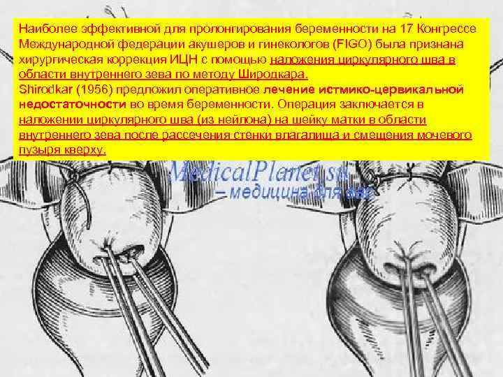 Наиболее эффективной для пролонгирования беременности на 17 Конгрессе Международной федерации акушеров и гинекологов (FIGO)