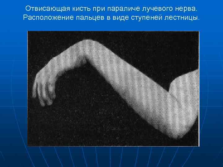 Отвисающая кисть при параличе лучевого нерва. Расположение пальцев в виде ступеней лестницы. 