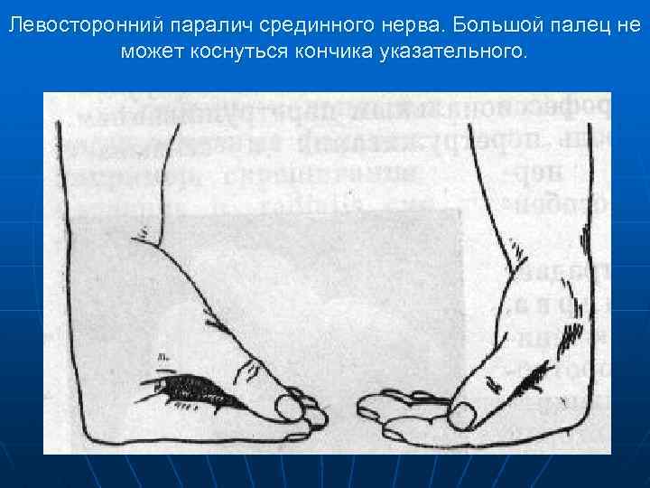 Левосторонний паралич срединного нерва. Большой палец не может коснуться кончика указательного. 