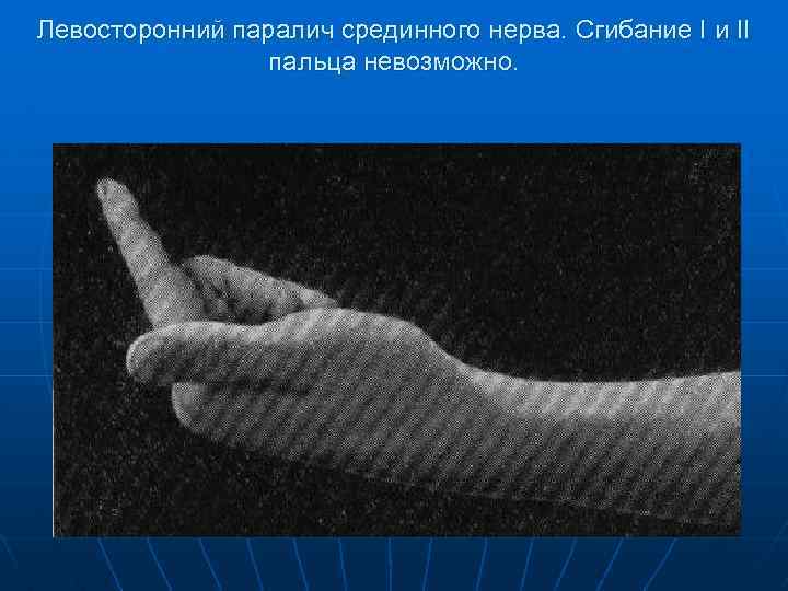 Левосторонний паралич срединного нерва. Сгибание I и II пальца невозможно. 