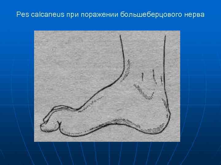 Pes calcaneus при поражении большеберцового нерва 