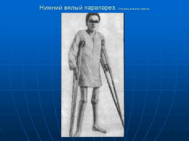 Нижний вялый парапарез. Опухоль конского хвоста. 