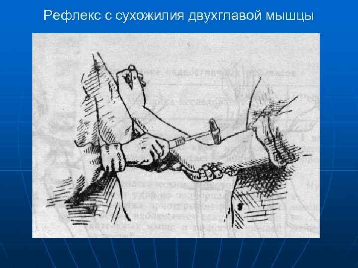 Рефлекс с сухожилия двухглавой мышцы 
