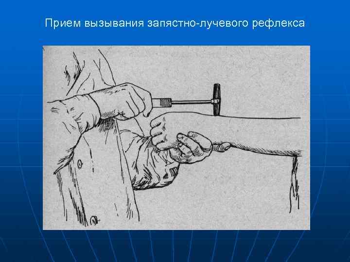 Прием вызывания запястно-лучевого рефлекса 