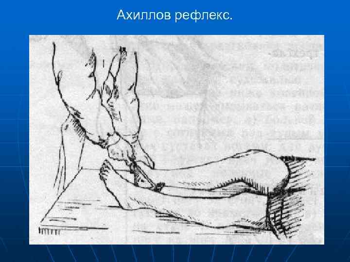 Ахиллов рефлекс. 