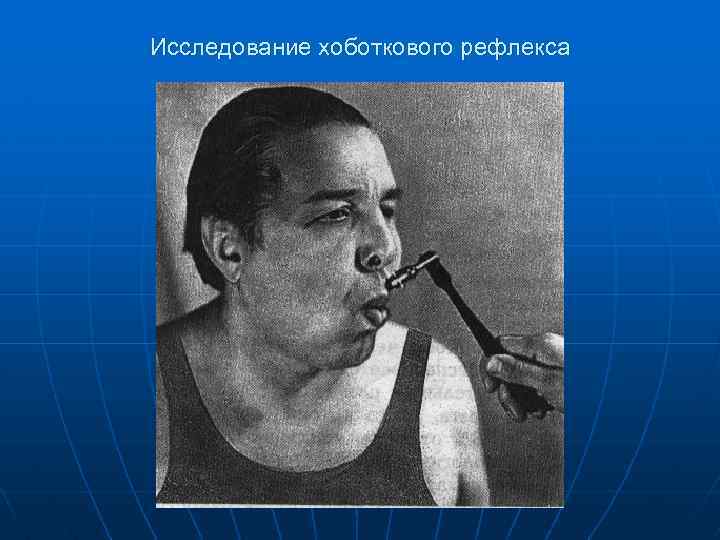 Исследование хоботкового рефлекса 