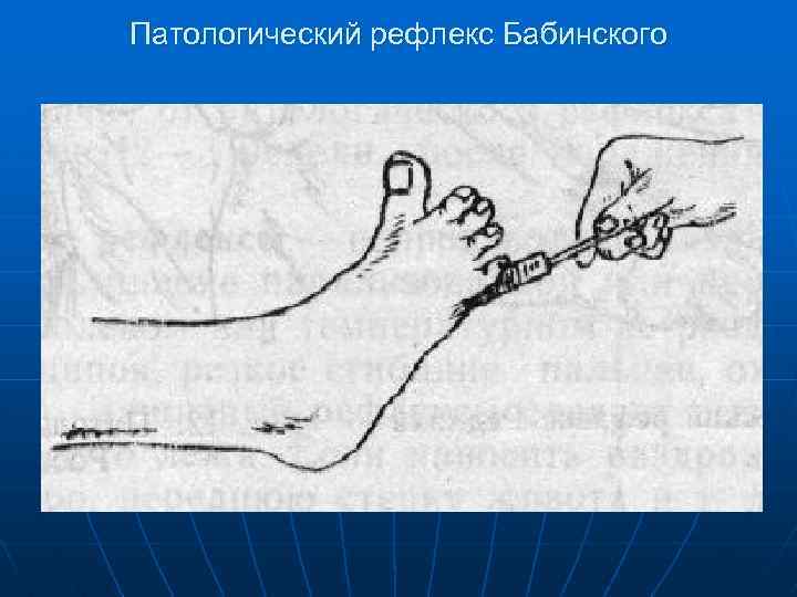 Патологический рефлекс Бабинского 