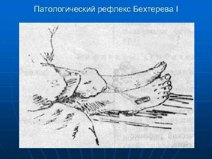 Патологический рефлекс Бехтерева I 