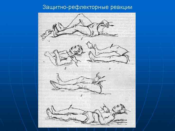 Защитно-рефлекторные реакции 