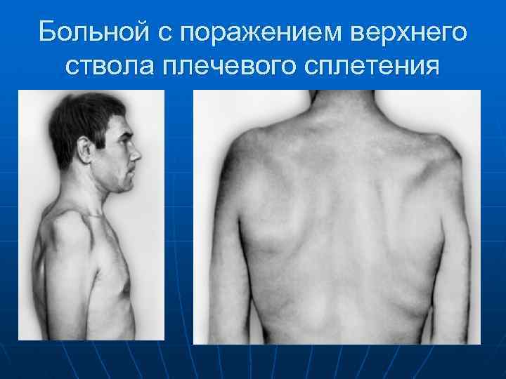 Больной с поражением верхнего ствола плечевого сплетения 