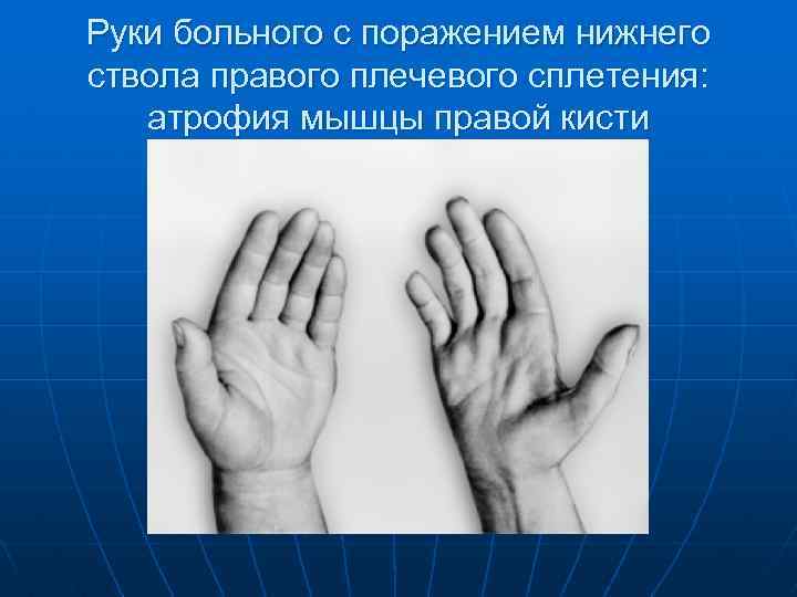 Руки больного с поражением нижнего ствола правого плечевого сплетения: атрофия мышцы правой кисти 