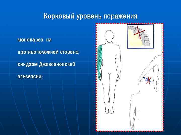 Корковый уровень поражения монопарез на противоположной стороне; синдром Джексоновской эпилепсии; 
