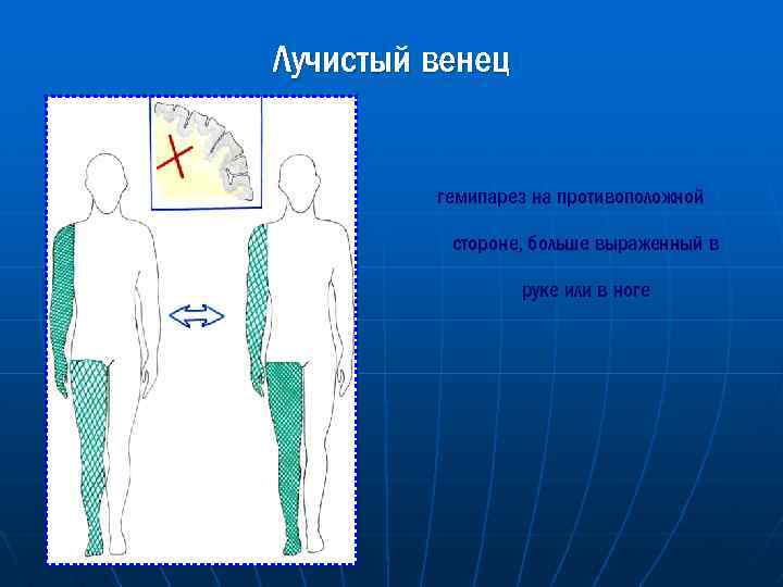Лучистый венец гемипарез на противоположной стороне, больше выраженный в руке или в ноге 